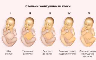 Желтуха у младенцев: почему возникает, что делать и как помочь?