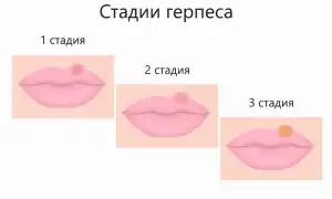 Как лечить герпес (простуду) на губах эффективно и безопасно
