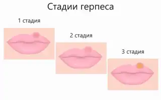 Как лечить герпес (простуду) на губах эффективно и безопасно
