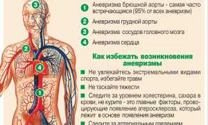 Найти аневризму: внешние признаки и симптомы у пациентов
