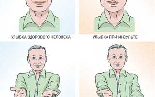 Признаки ‘тихого’ инсульта: что нужно знать