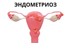Возможна ли беременность при эндометриозе? Важные аспекты и советы