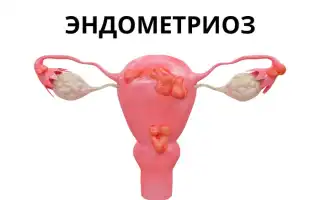 Возможна ли беременность при эндометриозе? Важные аспекты и советы