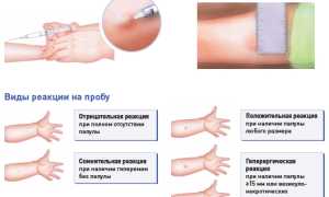 Диаскинтест (ДСТ) в школе: зачем его ставят и можно ли отказаться от процедуры?