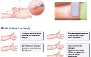 Диаскинтест (ДСТ) в школе: зачем его ставят и можно ли отказаться от процедуры?