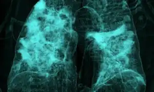 Влияние коронавируса на легкие: фото и клинические данные исследования