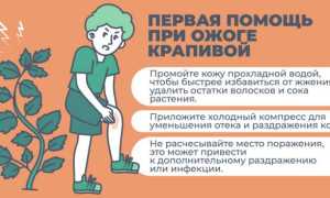 Крапивный ожог и как его лечить правильно