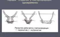 Раскрытие шейки матки у повторнородящих женщин