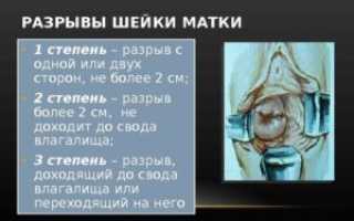 Разрывы при родах степени