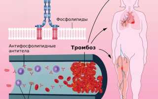 Антифосфолипидный синдром: причины возникновения, лечение и профилактика