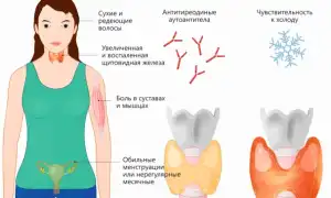 Аутоиммунный тиреоидит: что это такое и как с ним жить?