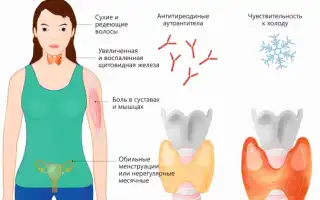 Аутоиммунный тиреоидит: что это такое и как с ним жить?