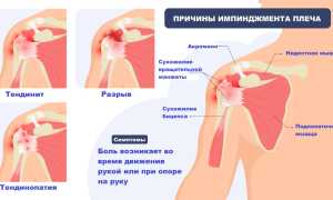 Слабость и боль в плечах: разбираемся, в чем причина и как помочь