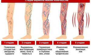 Как определить тромб — главные признаки и симптомы