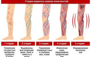 Как определить тромб — главные признаки и симптомы