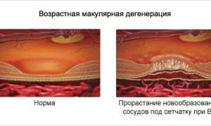 Возрастная макулярная дегенерация: симптомы и лечение для здоровья глаз