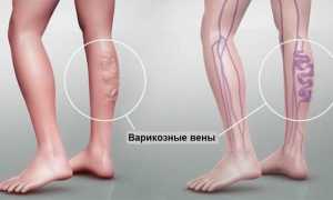 Варикоз ног: лечится он или нет? Узнайте больше о методах лечения