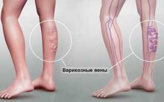 Варикоз ног: лечится он или нет? Узнайте больше о методах лечения
