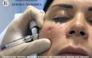 Инъекции филлеров от темных кругов — помогает ли это на самом деле?