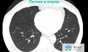 У болезни от вейпинга появилось название – EVALI, причины и последствия