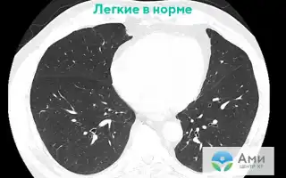 У болезни от вейпинга появилось название – EVALI, причины и последствия