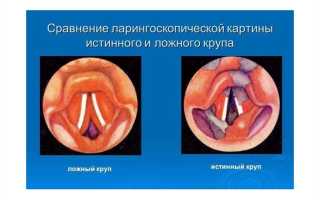 Истинный и ложный круп: в чем различие и как их различить правильно