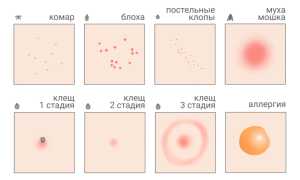 Как распознать укусы насекомых. Подробное руководство для всех