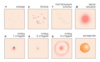 Как распознать укусы насекомых. Подробное руководство для всех