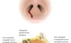 Кровь из носа идет со сгустками: что это может значить для здоровья?
