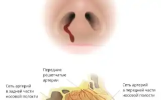 Кровь из носа идет со сгустками: что это может значить для здоровья?