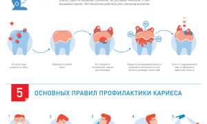 Как предотвратить кариес? Полезные советы и рекомендации