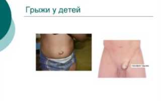 Грыжа у ребенка в паху