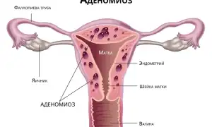 Аденомиоз — что это за болезнь и как с ней бороться?