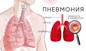 Пневмония (воспаление легких): как её вылечить эффективно и безопасно