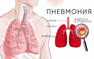 Пневмония (воспаление легких): как её вылечить эффективно и безопасно