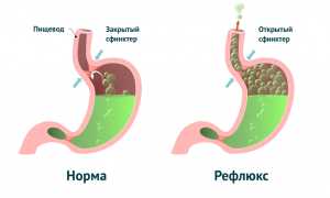 Газы в грудной клетке — почему это происходит и как с этим справиться?