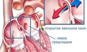 Овальное окно в сердце у новорожденного: причины и последствия