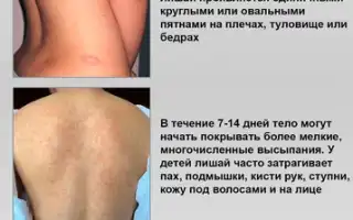 Лечение розового лишая у человека: что можно применить для улучшения состояния