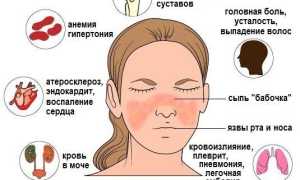 Волчанка и её связь с кишечником. Можно ли выключить аутоиммунную реакцию для улучшения здоровья?