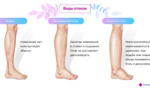 Почему по утрам затекают ноги: что это значит и как с этим справиться?