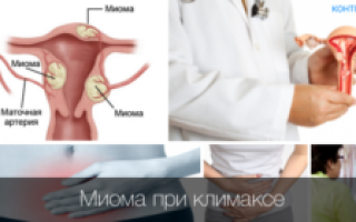 Миома при климаксе исчезает