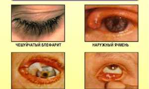 Как быстро вылечить ячмень на глазу народными средствами