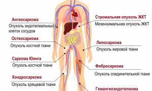 Что такое саркома кости: ранние признаки, симптомы и лечение заболевания