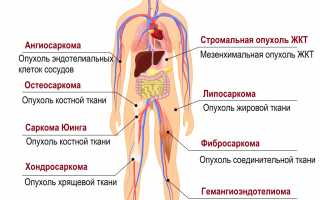 Что такое саркома кости: ранние признаки, симптомы и лечение заболевания