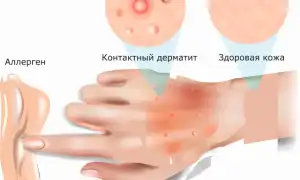 Аллергический контактный дерматит: диагноз и симптомы, причины возникновения