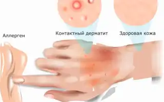 Аллергический контактный дерматит: диагноз и симптомы, причины возникновения