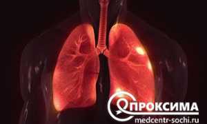 Асбестоз легких — симптомы и лечение, важные аспекты здоровья