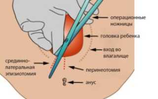 Эпизиотомия как ухаживать за швами