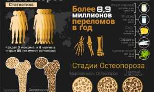 Симптомы остеопороза у мужчин. Опасен ли он для здоровья?