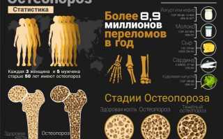 Симптомы остеопороза у мужчин. Опасен ли он для здоровья?